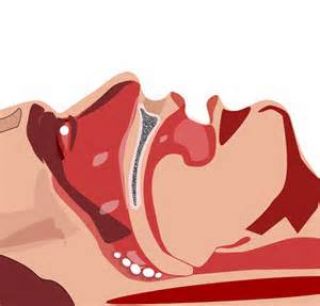 Often, as a result of trauma, a patient will have some sort of slowing or blockage in their airway. How do you open it back up?