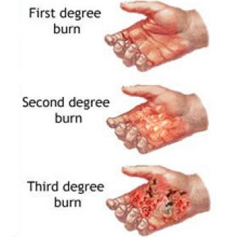 Which of the following is an INCORRECT treatment for a first degree burn?