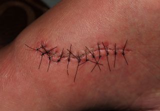 How do you know if a cut will need stitches?